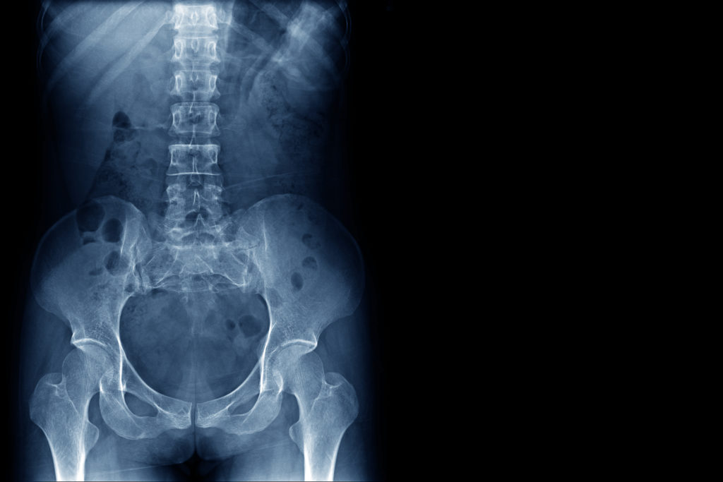 x-ray image of human normal spine, rips, pelvis, both hip joint and blank area at right side